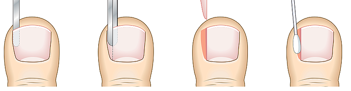 Ingrown toenail phenolisation procedure