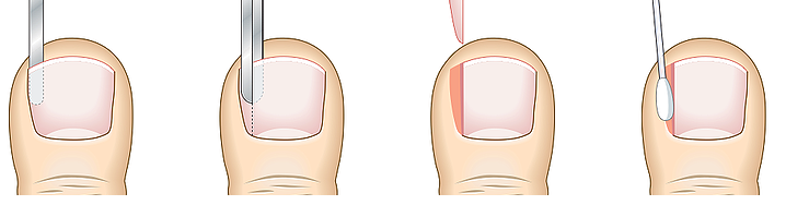 Ingrown toenail surgery | Podiatric Surgeon Perth | Dr Ned Buckley