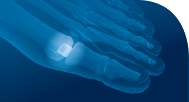 Treatment for Arthritic Big Toe Joints (Hallux Rigidus) - Perth Foot Centre